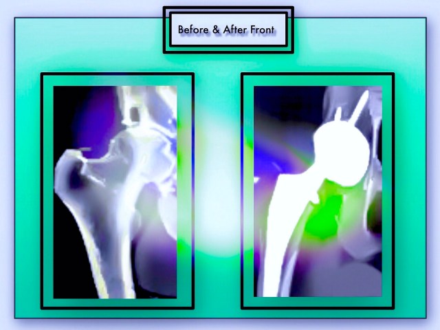 Below: My Before & After X-rays. A Hip Replacement Involves Removing A Large Amount of Bone That Comprised the Original Hip Joint and Replacing It with Titanium & Plastic Protheses