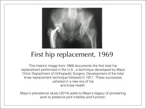 Mayo's in 1969 is Generally Regarded as the 1st Modern Day Hip Replacement