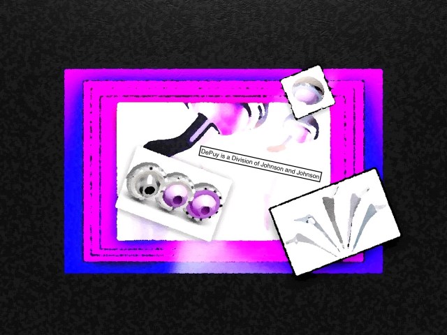 Below: My prothesis is made by DePuy